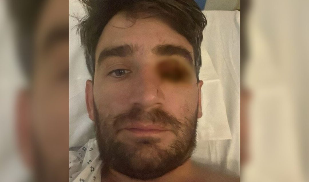 Hombre pierde un ojo en fiesta de Año Nuevo por explosión de fuegos pirotécnicos