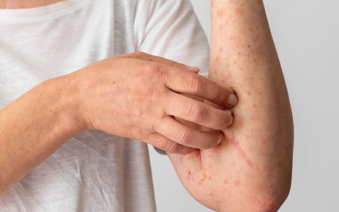 Nuevo León Reporta 33 Casos de Sarampión en 2026: ¿Es una Epidemia en Puerta?