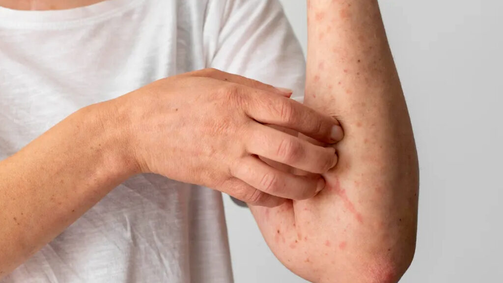 Guanajuato Registra 6 Nuevos Casos de Sarampión, Advierte la Secretaría de Salud