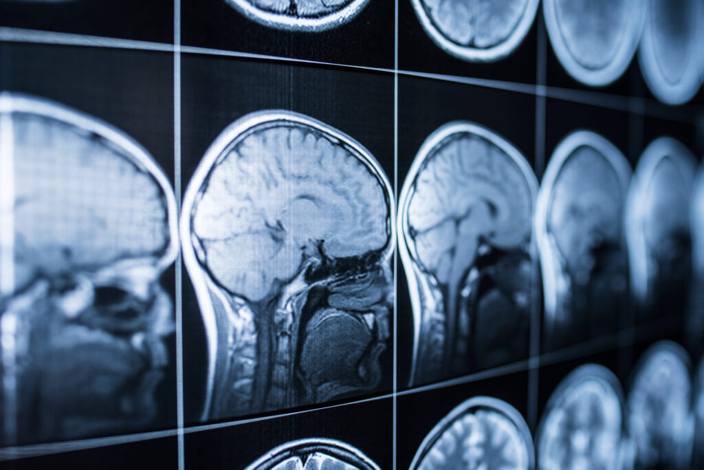 Más de 500,000 residentes en Colorado enfrentan secuelas de lesiones cerebrales: Evaluación gratuita disponible