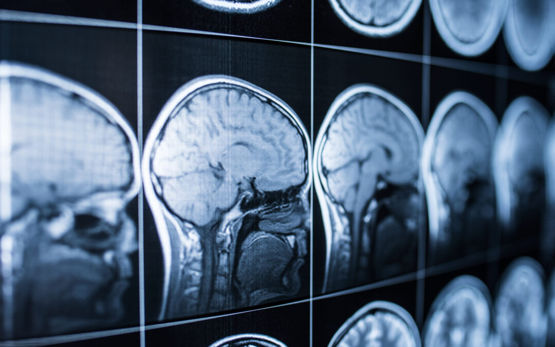 Más de 500,000 residentes en Colorado enfrentan secuelas de lesiones cerebrales: Evaluación gratuita disponible